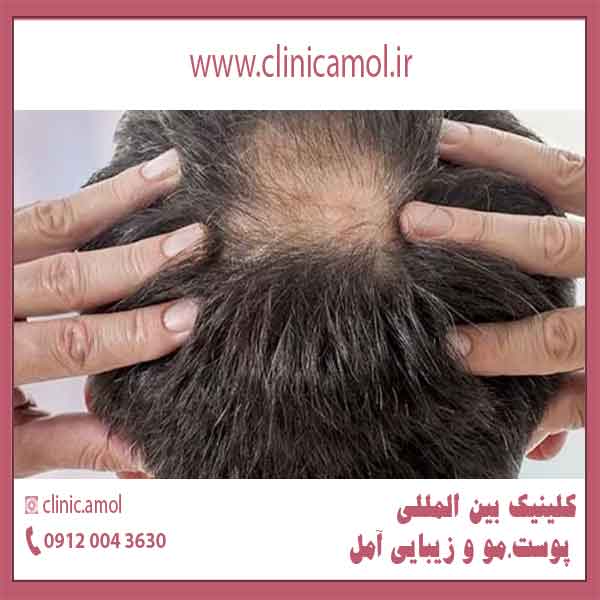 جلوگیری از ریزش مو _ راهکارهای موثر در درمان ریزش مو